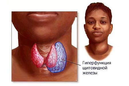 Гипотиреоз щитовидной железы