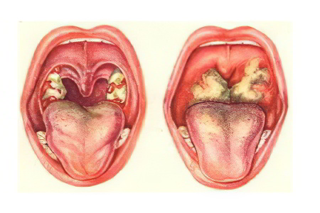Гнойный фарингит