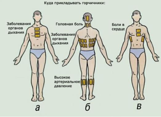 Можно ли ставить горчичники при бронхите взрослым и детям и куда правильно поставить: лечебные свойства и принцип действия, инструкция к применению и противопоказания, как добиться максимального эффекта от процедуры