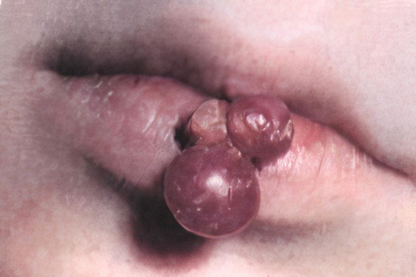 гранулема губы