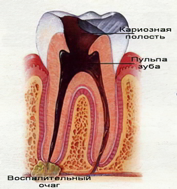 гранулема гранулема