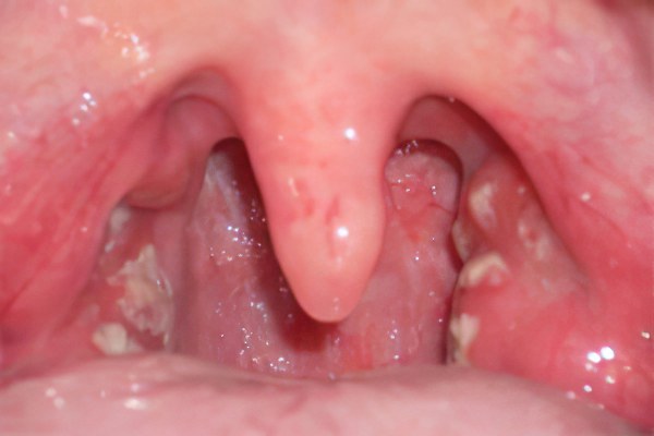 Грибковая инфекция горла