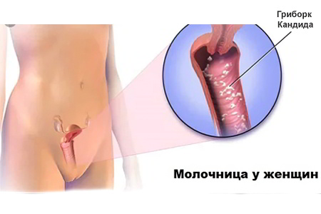 Молочница у женщин причин лечение