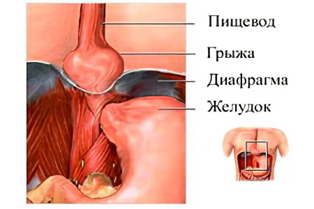 Грыжа пищеводного отверстия диафрагмы