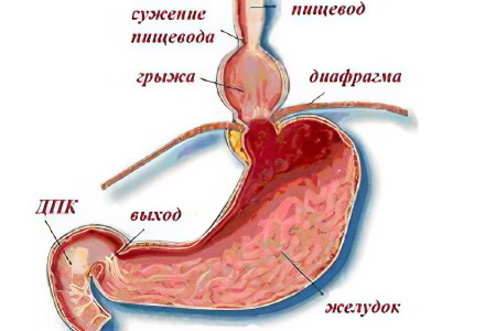 Грыжа пищевода - симптомы и признаки, диагностика, лечение и питание