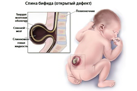 Спинномозговая грыжа у новорожденных детей