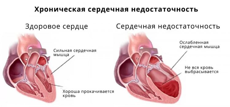 Заболевания сердечно-сосудистой системы