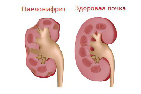 Хронический пиелонефрит