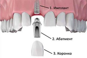 Импланты зубов