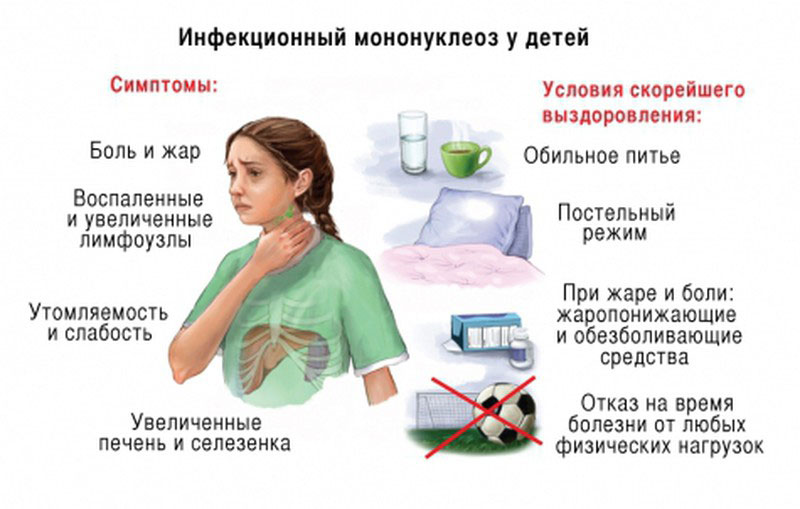 Инфекционный мононуклеоз Инфекционный мононуклеоз