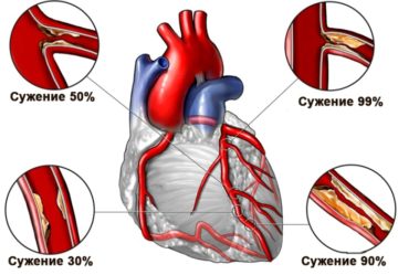 Сердце и тромболизис
