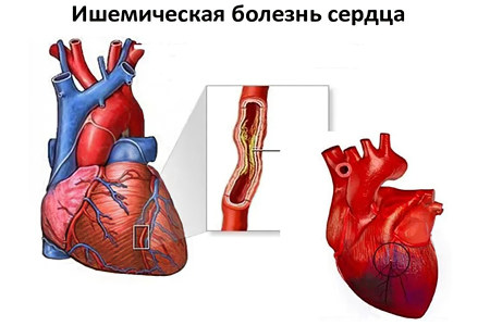 ишемическая болезнь сердца