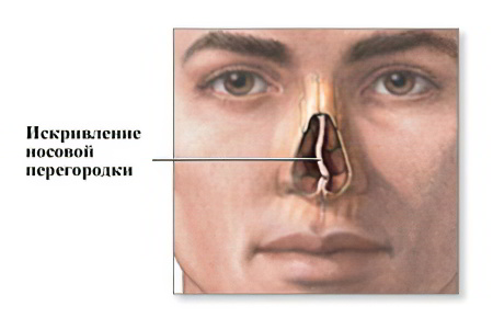 Искривление носовой перегородки