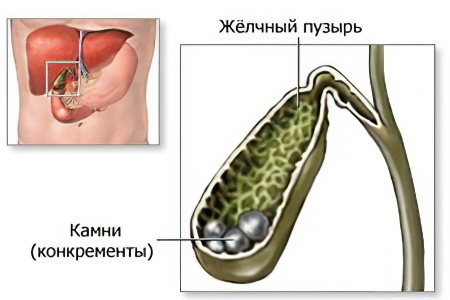 желчнокаменная болезнь