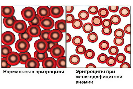 Железодефицитная анемия