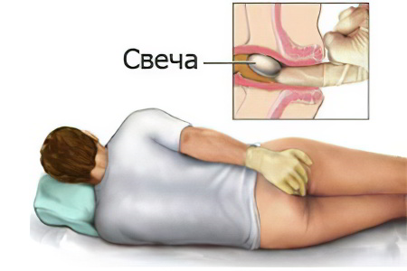 Как правильно поставить свечи от геморроя?