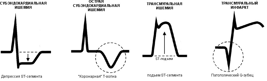 Как обнаружить острую гипоксию