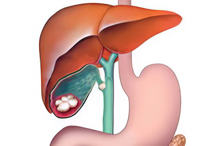 калькулезный холецистит