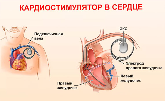 имплантации кардиостимулятора