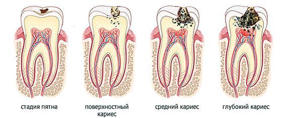 Кариес стадии Кариес стадии