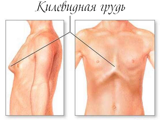 Килевидная деформация грудной