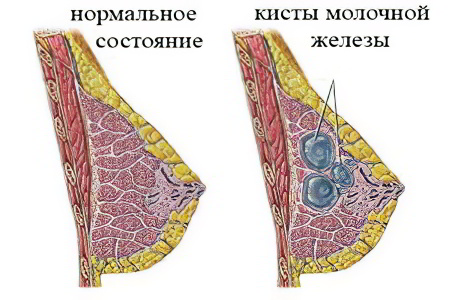 Киста молочной железы