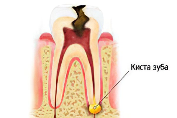 Межкорневая киста зуба лечение