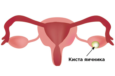 Киста яичников Киста яичников