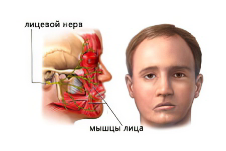 Классификация лицевого неврита