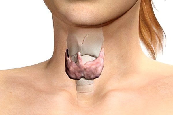 Коллоидный зоб щитовидной железы