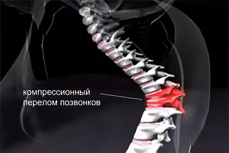компрессионный перелом позвоночника компрессионный перелом позвоночника