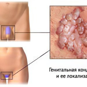 кондилома у женщин кондилома у женщин
