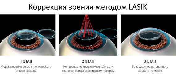 Метод LASIK Метод LASIK