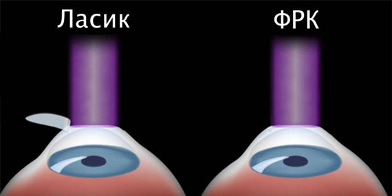 Метод транс-ФРК Метод транс-ФРК