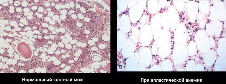 Апластическая и гипопластическая анемия