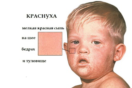 Краснуха Краснуха