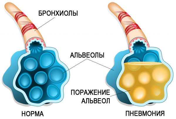 Крупозная пневмония