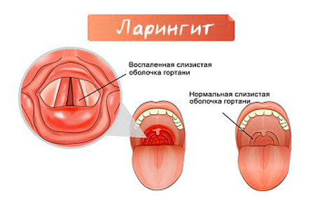 Ларингит