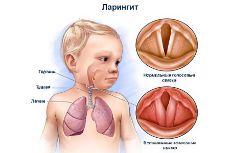 Виды ларингита