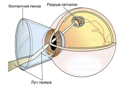 лазерная коагуляция