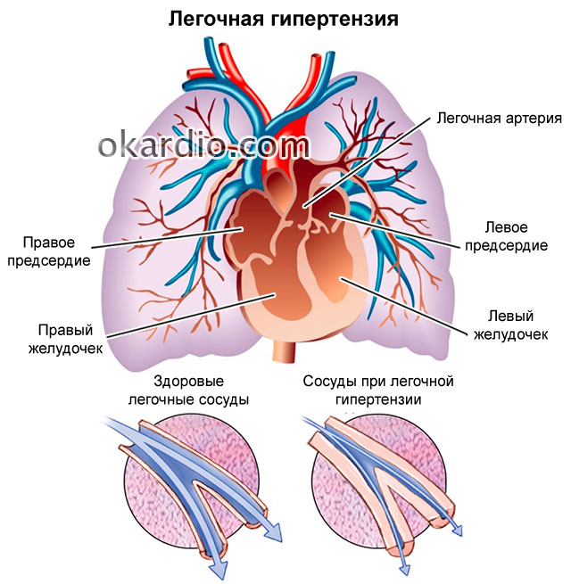 Симптомы и лечение лёгочной гипертензии