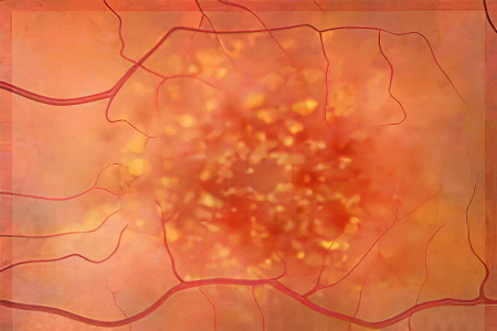 макулодистрофия сетчатки глаза