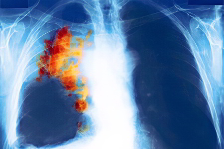 Метастазы при раке лёгких