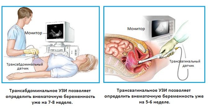 Трансвагинальное УЗИ