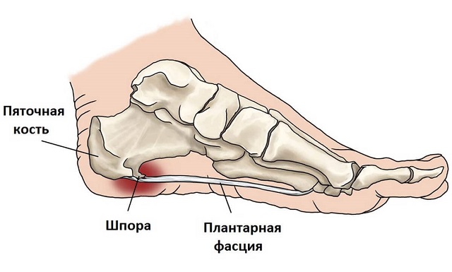 Пяточная шпора