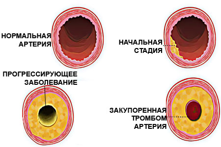 Холестерин