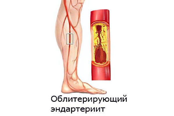 Облитерирующий эндартериит