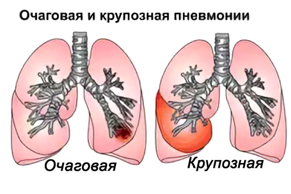 Очаговая пневмония