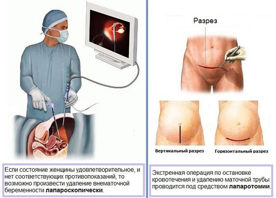 Экстренная операция при разрыве маточной трубы