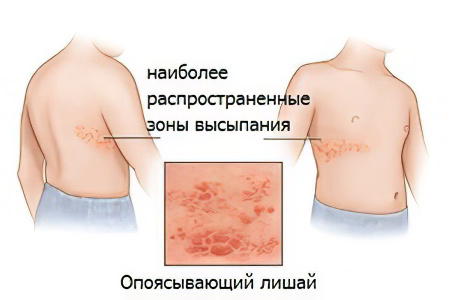 Лечение после опоясывающего лишая 14